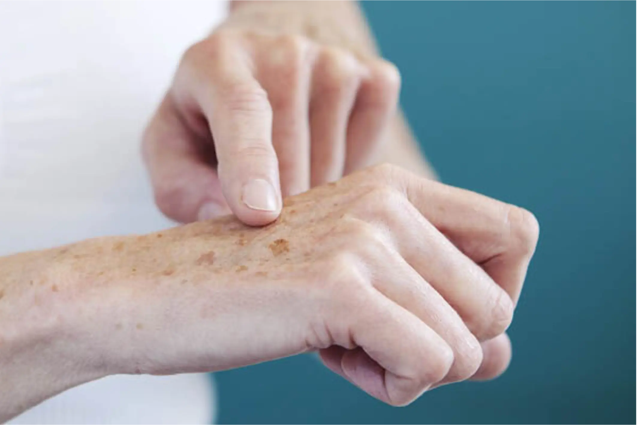 ¿Tienes manchas por sol, melasma o hiperpigmentación?