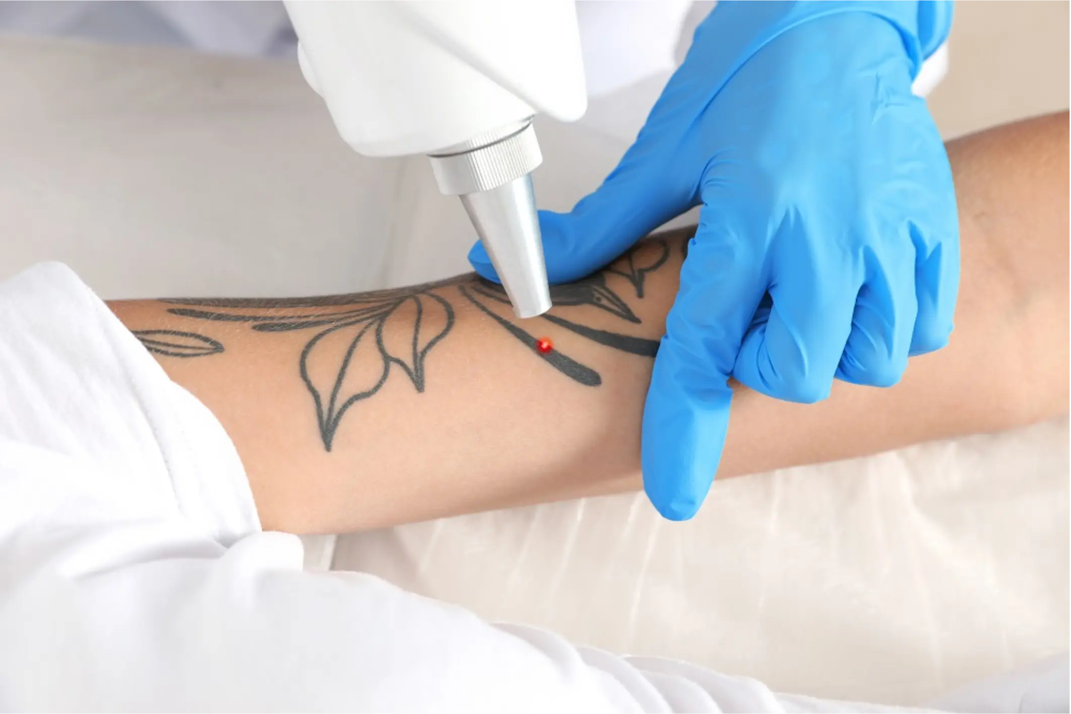 Tratamiento de eliminación de tatuajes con láser