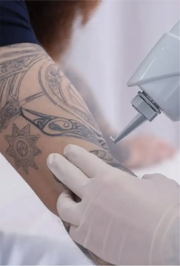 Eliminación de Tatuajes